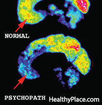 Den psykopatiske hjernen har vært et interesseområde i forskning for å prøve å bestemme hvordan psykopater tenker, men hvor forskjellig er hjernen til en psykopat?