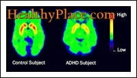 Begrepene ADD og ADHD er blitt brukt om hverandre. Imidlertid er den oppdaterte termen, ifølge DSM IV, ADHD (Attention Deficit Hyperactivity Disorder).